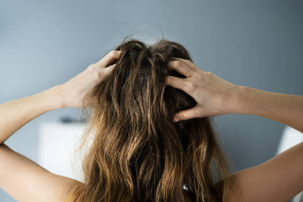 5 razones de la picazón en el cuero cabelludo y cómo aliviarlo